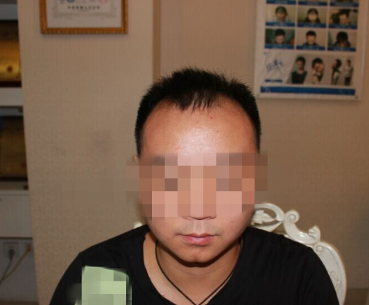 成都大麦微针植发2900单位，希望可以帮助大家重拾自信