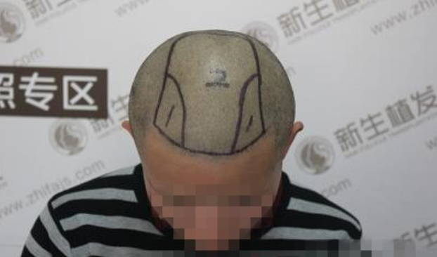 南京新生植发3500单位，爱美之心人皆有之