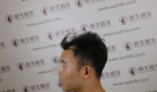 脱发五年了，南京新生终于让我睡上一个安稳觉