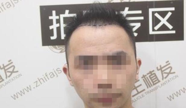 南京新生植发4000单位，感谢植发让我从”无”到“有”