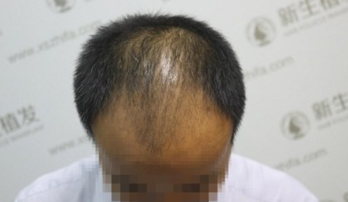 南京新生植发3940单位，对“中年大叔”说拜拜！