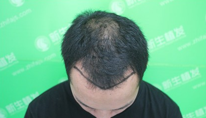 6级脱发在广州新生植发后成了这样，来看看前后对比图