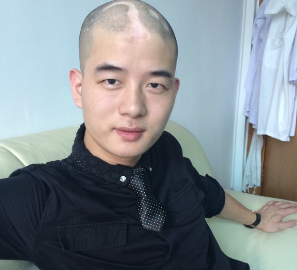 广州植发2700单位，从此在自信中奔跑