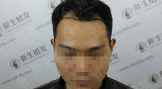 广州新生植发案例，管先生说以后再也不用过双十一了