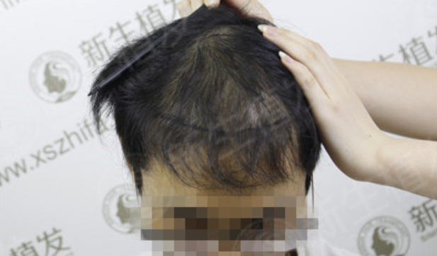 四级脱发显人老，杭州新生植发2500单位转眼变成年轻小伙子