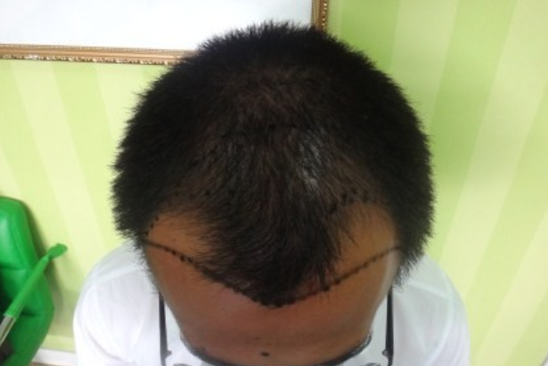 来杭州新生改变，植发2500单位让笑容更自信