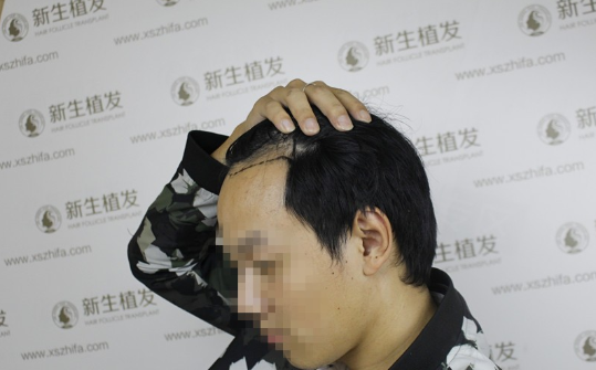 南京新生植发2500单位，亲身经历感觉南京新生真是太给力了