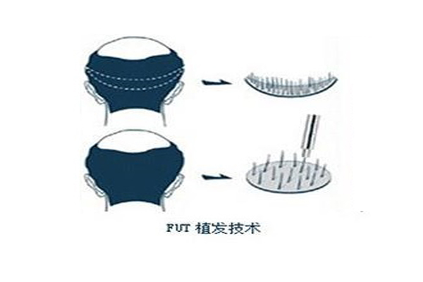 植发手术你了解吗?