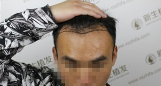 广州新生植发，植完发后他们都说我变了