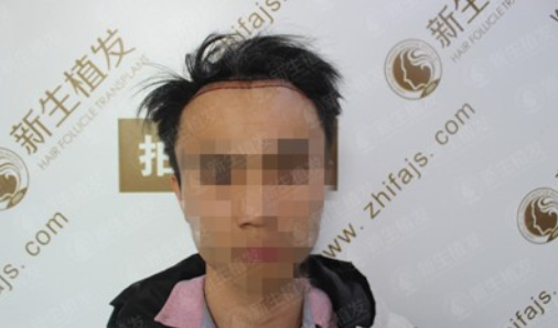 广州新生植发发际线种植，自此以后又多了一个纪念日