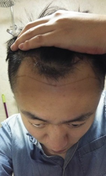 发际线种植1800单位，六个月蜕变历程