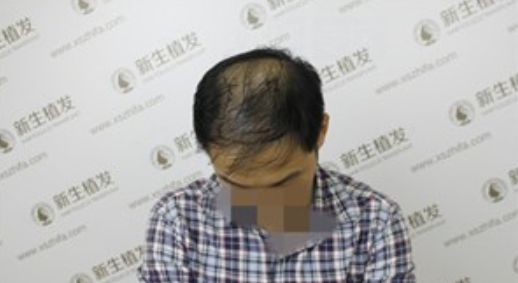 6级脱发，广州新生植发对我做了什么！