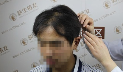 杭州新生植发，远离脱发改变形象
