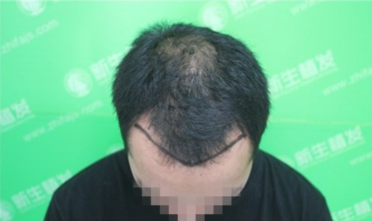 杭州新生植发2800单位，拯救M型发际线