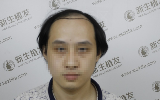 南京新生植发案例，超大面积脱发南京新生改变了我的人生