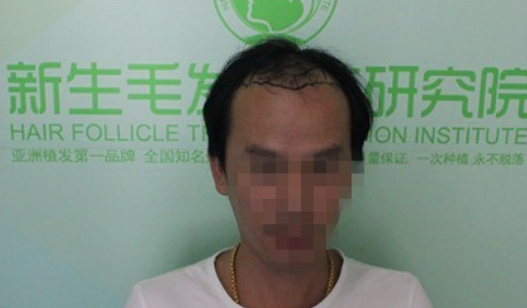 杭州新生植发2800单位，自信的魅力重新归来