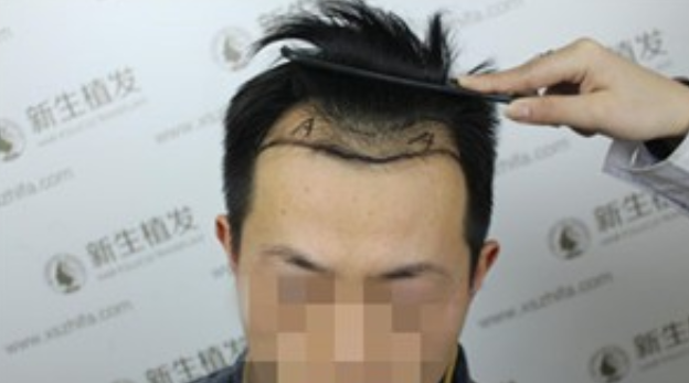 广州新生的3级脱发植发经历，2200毛囊单位快来看看