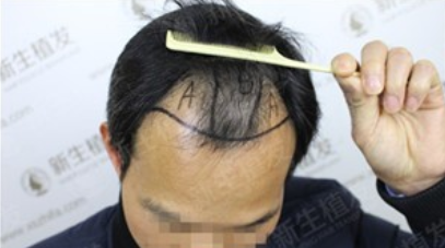 广州新生植发2500单位，完美诠释帅气二字