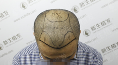 六级脱发？不要怕，广州新生植发带你彻底摆脱困境