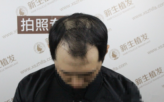 南京新生植发后，好的效果彻底改变了我