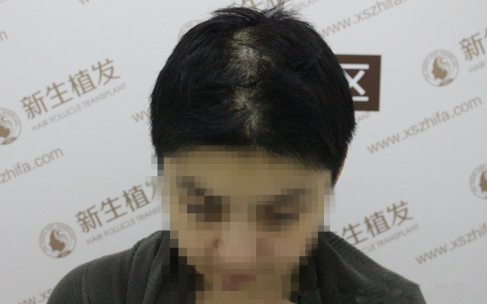 感恩南京新生植发，帮我拯救了我最重要的形象