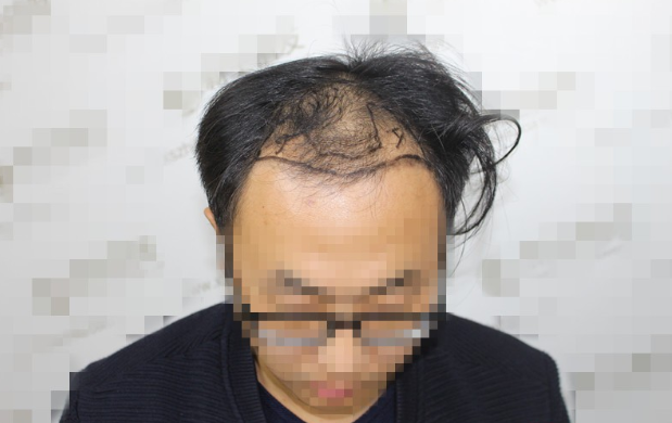 南京新生植发案例植发这事拖不得，越拖越脱！