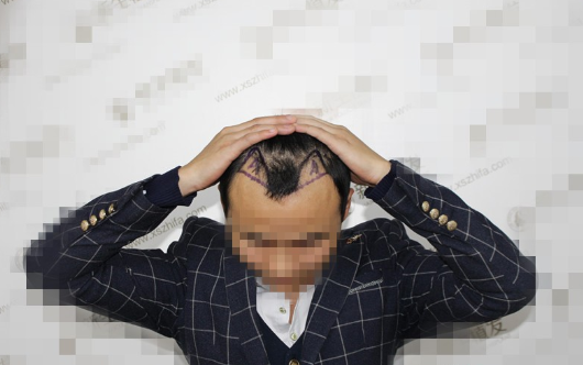 南京新生植发案例，一次心动改变我一生的自信