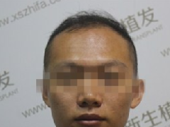 杭州新生植发案例，从大叔变成小鲜肉的过程