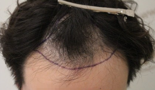 杭州新生植发案例，这家医院可谓是脱发的终结者