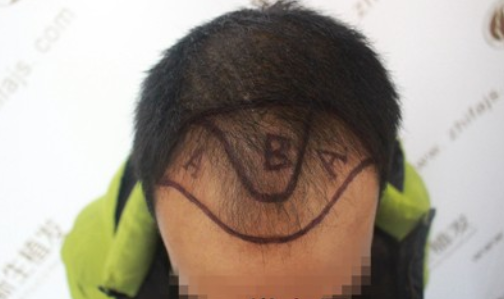 新生植发医院案例：不要在说90后脱发了，我是00后都脱发了！