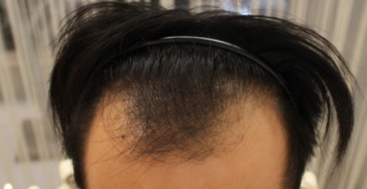 上海大麦微针FUE+PTT3200单位，慢慢向帅气靠近