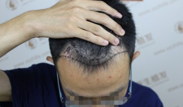 杭州新生植发1500单位，额头变小帅气变大