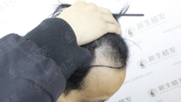 总是不敢抬头怎么办？广州新生植发2000单位帮你圆梦