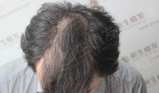 新生植发3300单位，男人也要注意自己的形象