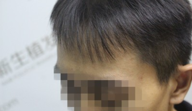 广州新生植发，不用羡慕别人的发际线了别人有的你也可以有