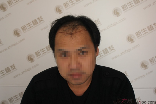 南京新生植发医院，让我的头发“化腐朽为神奇”