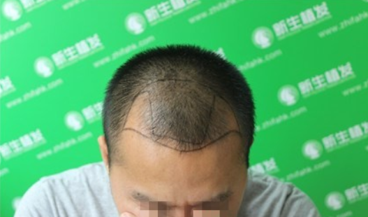 新生植发案例：健身达人难敌脱发困扰