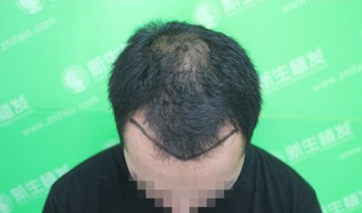 杭州新生植发：终于帮助我摆脱多年的脱发困扰了