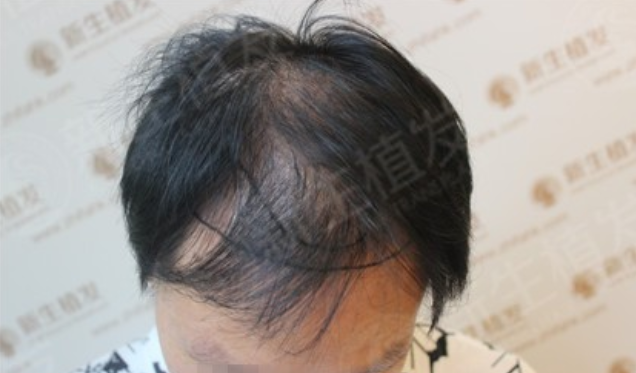 广州新生植发医院，“段先生”的大叔形象改造