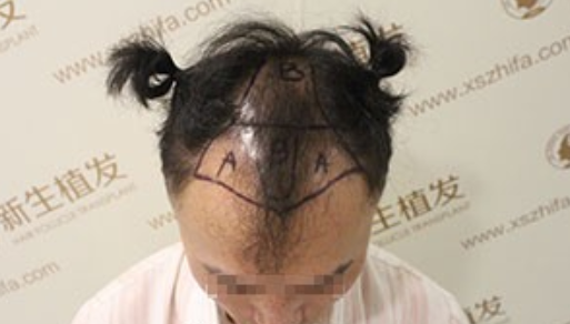 南京新生植发案例：用事实证明我的选择没有错