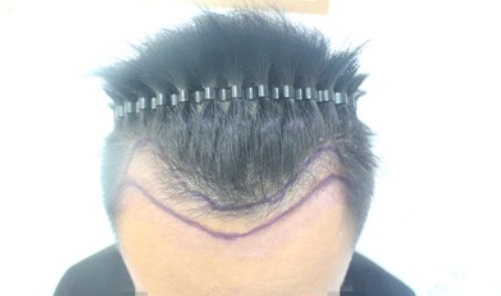 广州新生植发1500毛囊单位，高额头彻底远离我