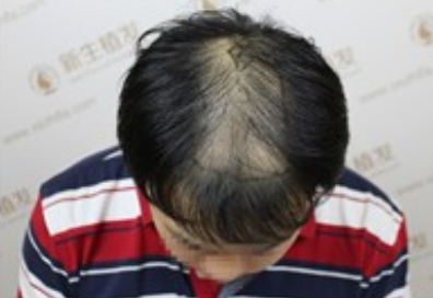 幸好遇见了南京新生植发，不然四级脱发简直让我愁死了