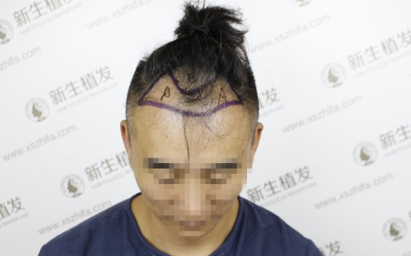 在南京新生植发后，起码年轻了十岁这感觉真的是“爽”