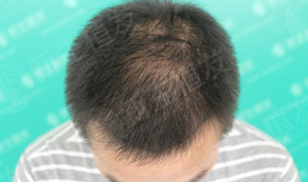 广州新生植发案例，趁着年轻奋斗但别忘了你的身体