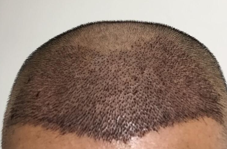 记录深圳大麦微针植发，期待已久的“茂密森林”终于出现