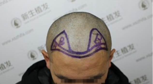 额角后退留长发欲盖弥彰？有广州新生在不用怕这些