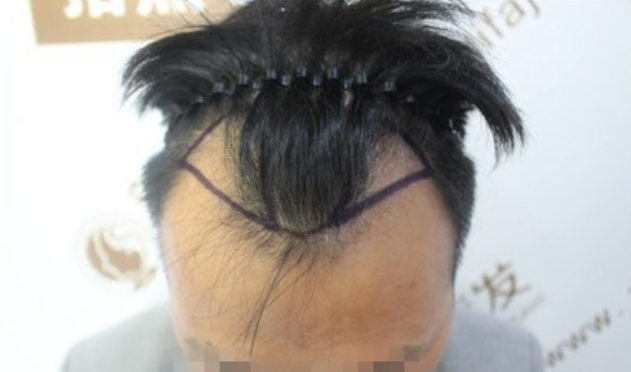 杭州新生植发：把我的面子找了回来从此不再脱发