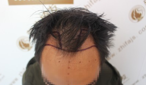 广州新生植发1500毛囊，让我的额角布满秀发