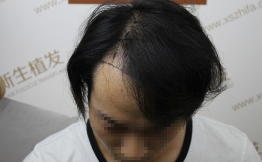 脱发的痛苦，南京新生植发医院帮我解决了来看前后对比图