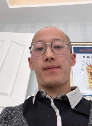 杭州大麦微针植发经历，来看看我的术前术后